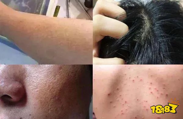 床上放个它，1000W螨虫集体自杀，比太阳暴晒强10000倍，每天不到一毛钱！