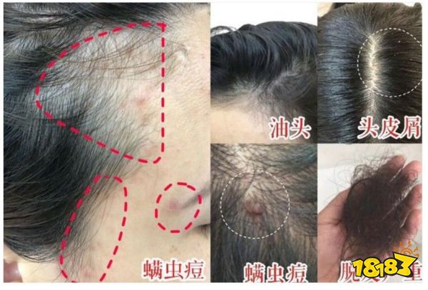 床上喷喷它，让千万螨虫集体自杀，比太阳暴晒强10000倍