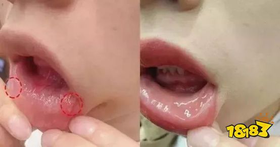 难怪韩国明星牙齿都那么白!都在用这支黑管精华，口臭、牙龈出血、龋齿……1支全解决!